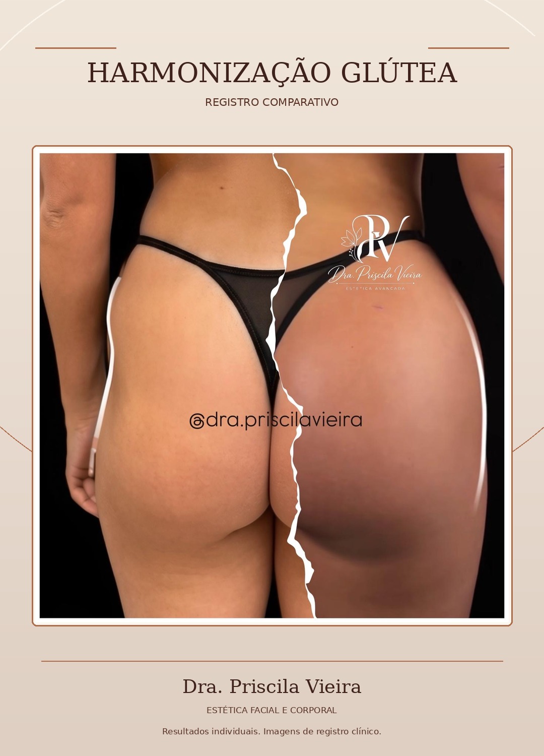 Registro fotográfico comparativo da região glútea