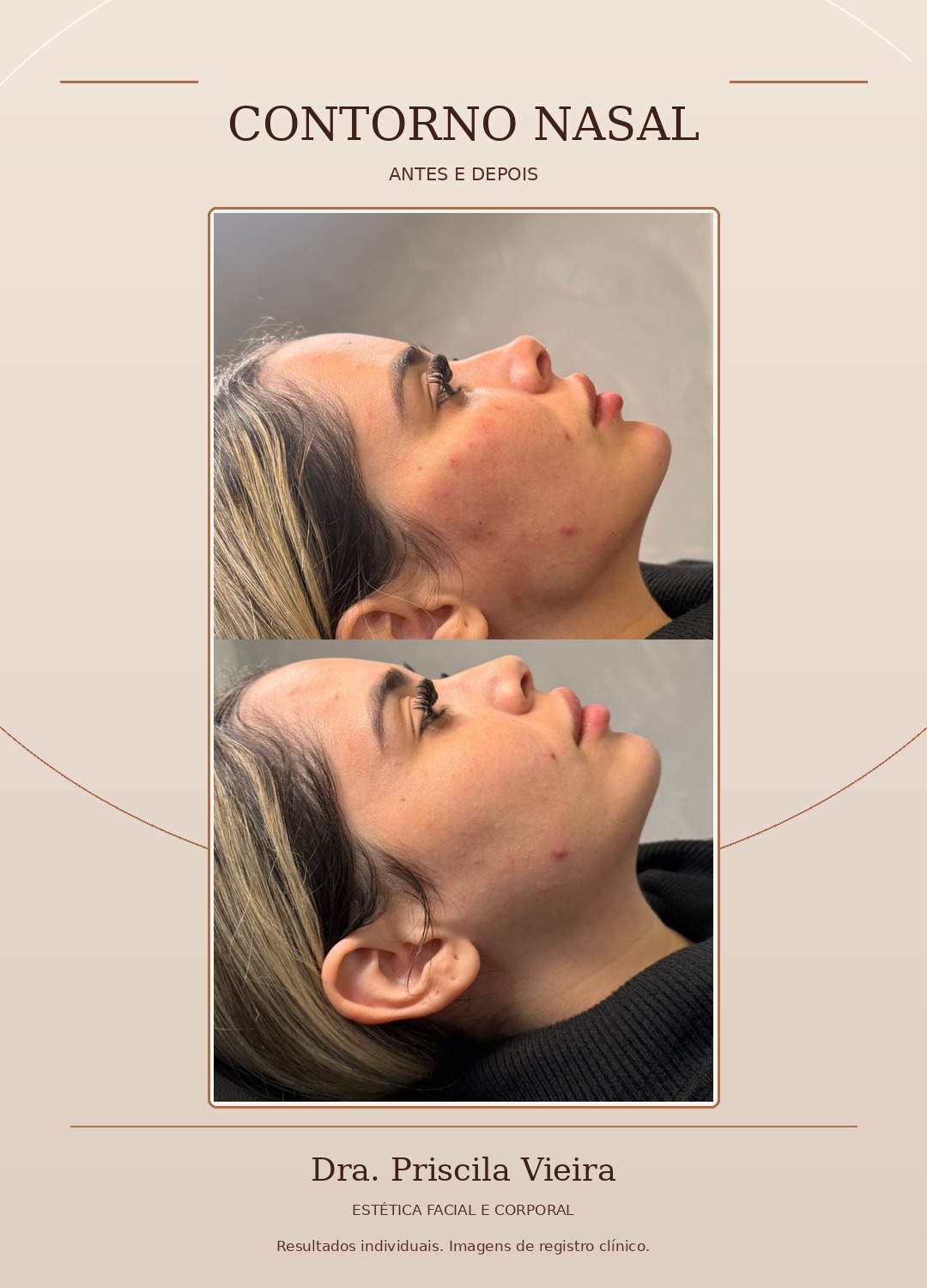 Comparativo fotográfico do perfil nasal, antes e depois
